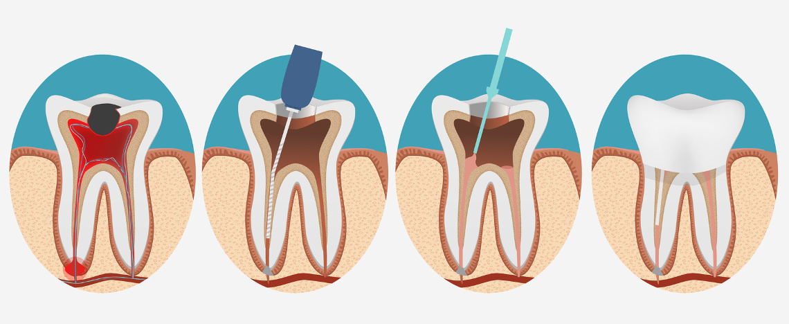 Endodonzia Melzo